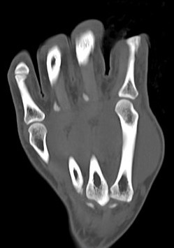 right 3rd metacarpal fx icd 10